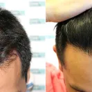 DHI Global - Beware of DHI (Direct Hair Implantation) - Photo 1 - comment #1967449