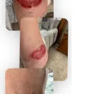 Siamak Agha, MD, PhD, FACS - Bad & disfiguring results/causing restriction of movement - Photo 1 - comment #2554968