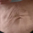 Sono Bello - venus treatment and lipo - Photo 1 - comment #2087427